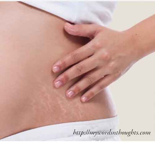 How to get rid of those stretch marks?