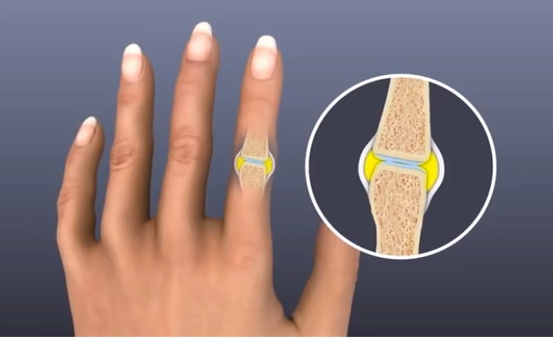 swelling of Rheumatoid Arthritis